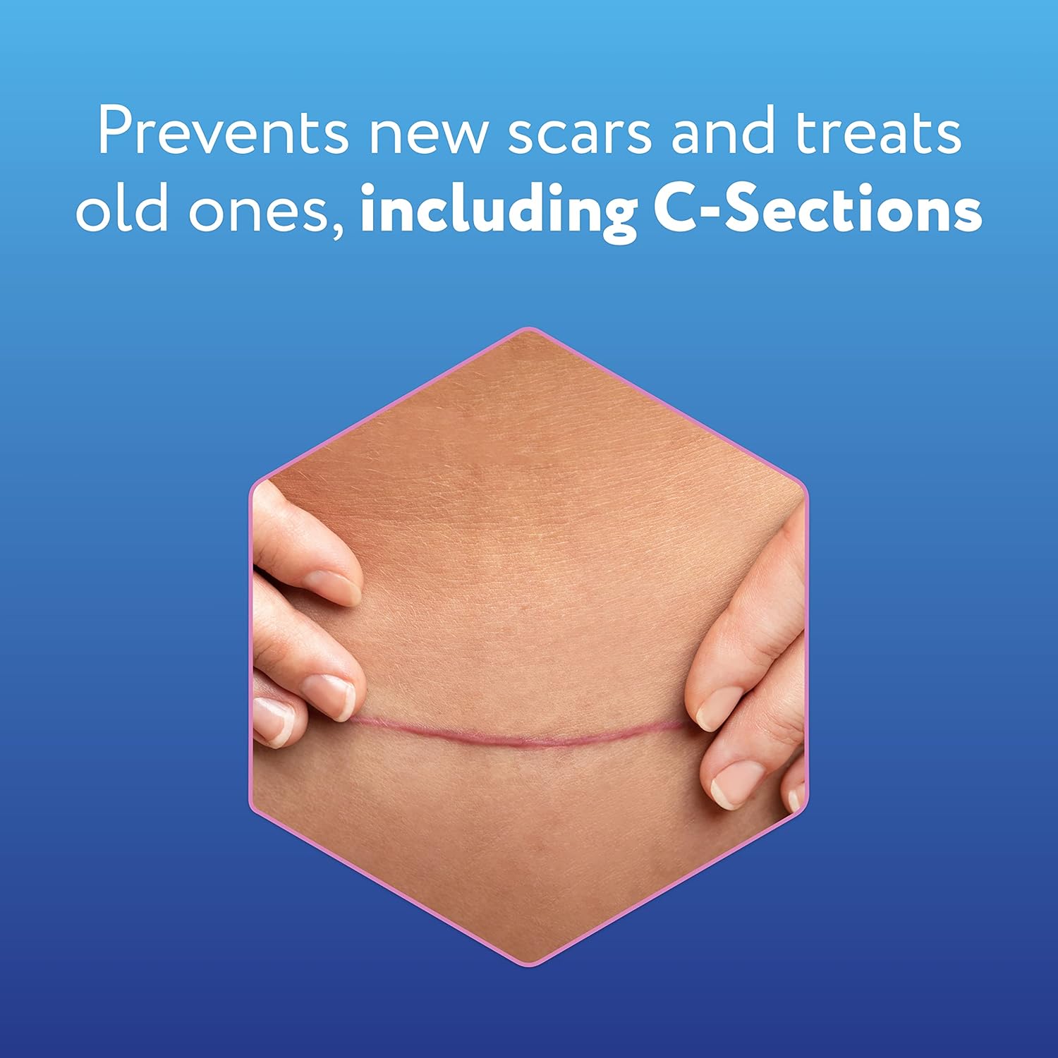 Reusable Silicone Scar Sheets (1.5” x 7”), 4 Sheets I2835