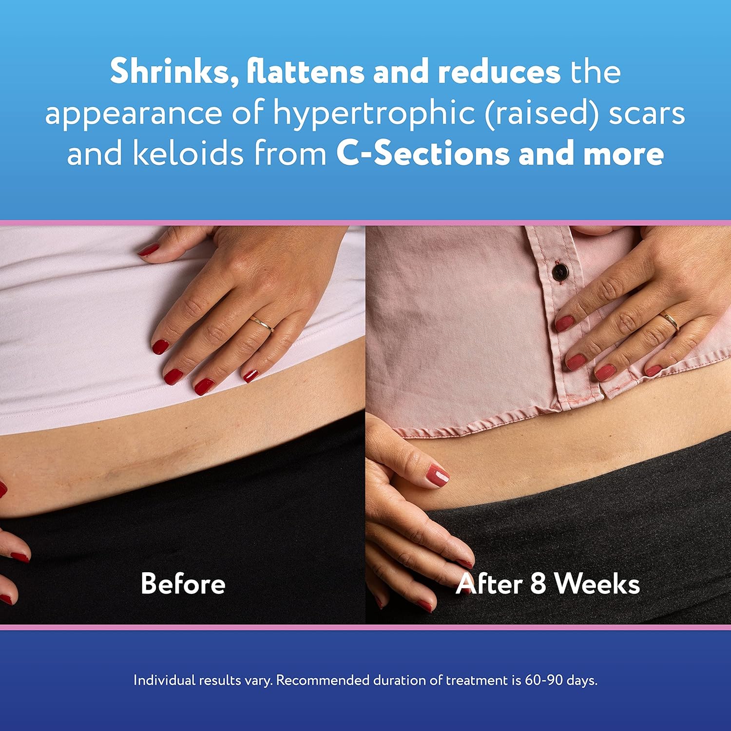 Reusable Silicone Scar Sheets (1.5” x 7”), 4 Sheets I2835